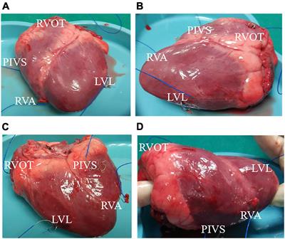 Optimization of Left Ventricle Pace Maker Location Using Echo-Based Fluid-Structure Interaction Models